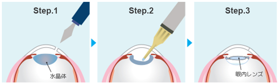 白内障手術では何をするの？