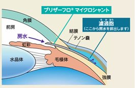 緑内障手術（インプラント挿入術）