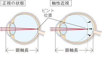 近視の進行を抑制することが大切な理由