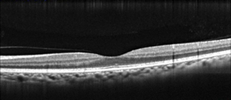 正常な網膜断面