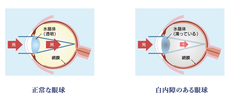 白内障の原因