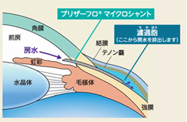 緑内障手術（インプラント挿入術）
