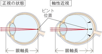 近視の進行を抑制することが大切な理由