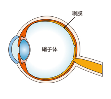 網膜硝子体(もうまくしょうしたい)手術｜福岡の川原眼科